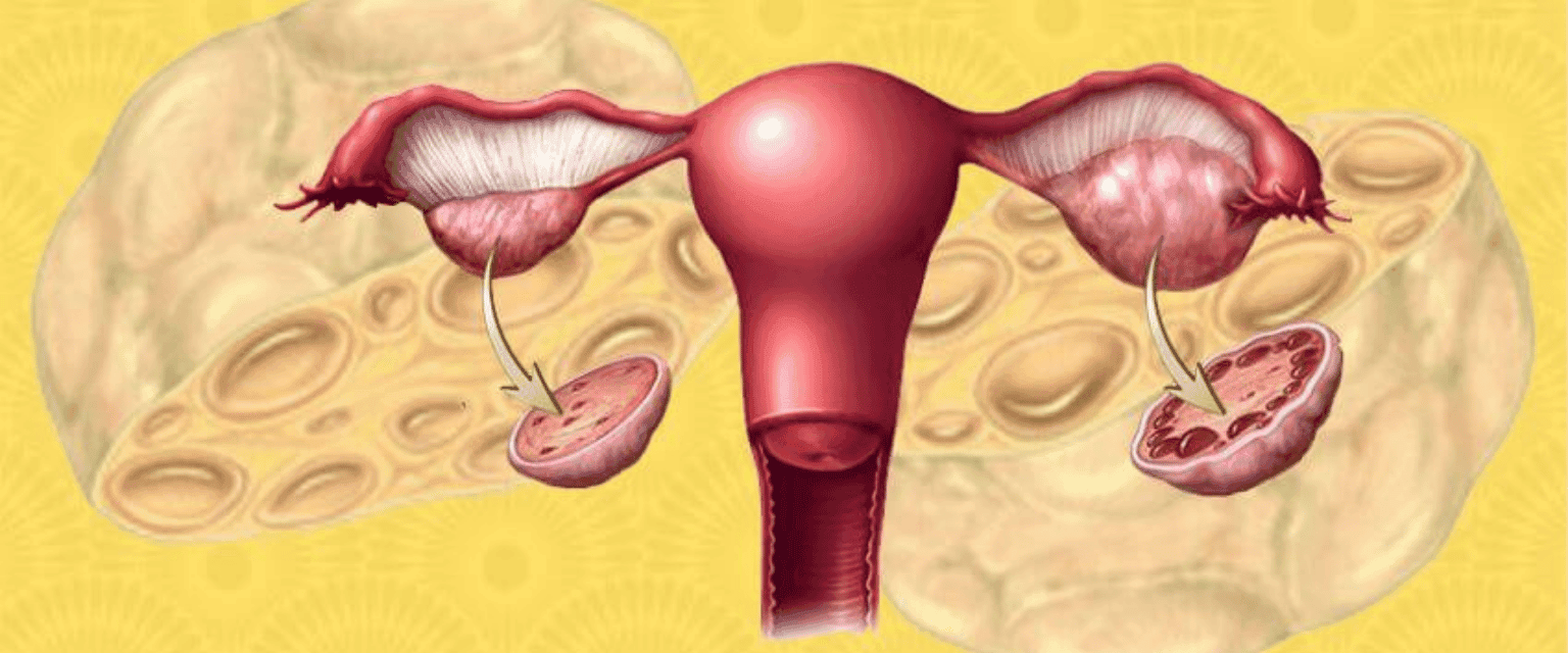 Polycystic ovarian syndrome, Infertility and obesity