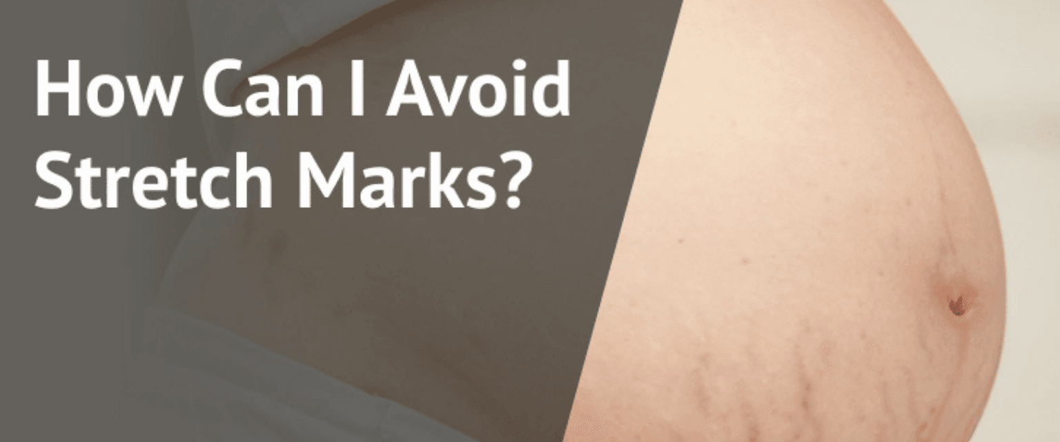 How Can I Avoid Stretch Marks?