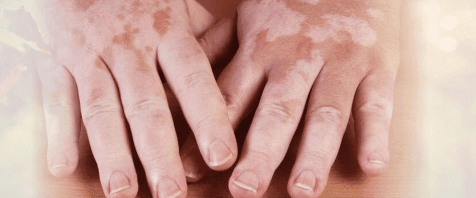 What is Skin Care Vitiligo (Leucoderma)? Explains Dermatologist