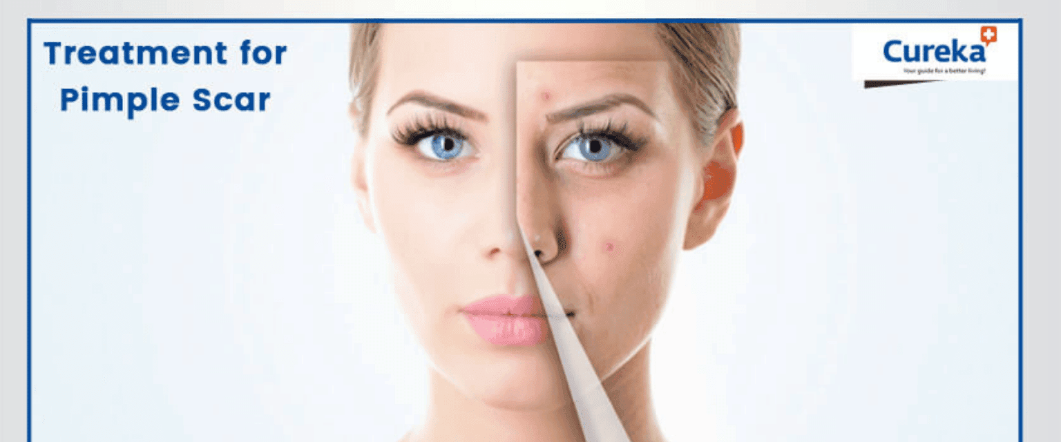 Treatment for Pimple Scar