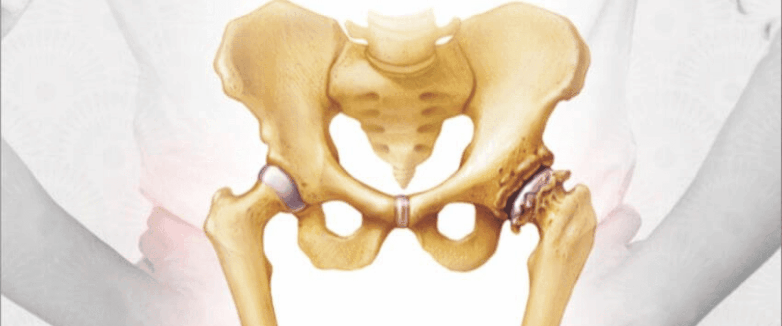 Total Hip Replacement