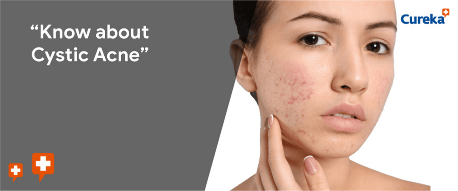 Know about Cystic Acne