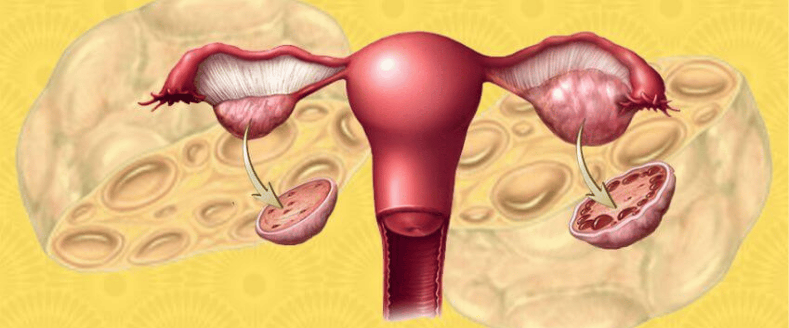 WHAT IS POLYCYSTIC OVARIAN SYNDROME (PCOS)?