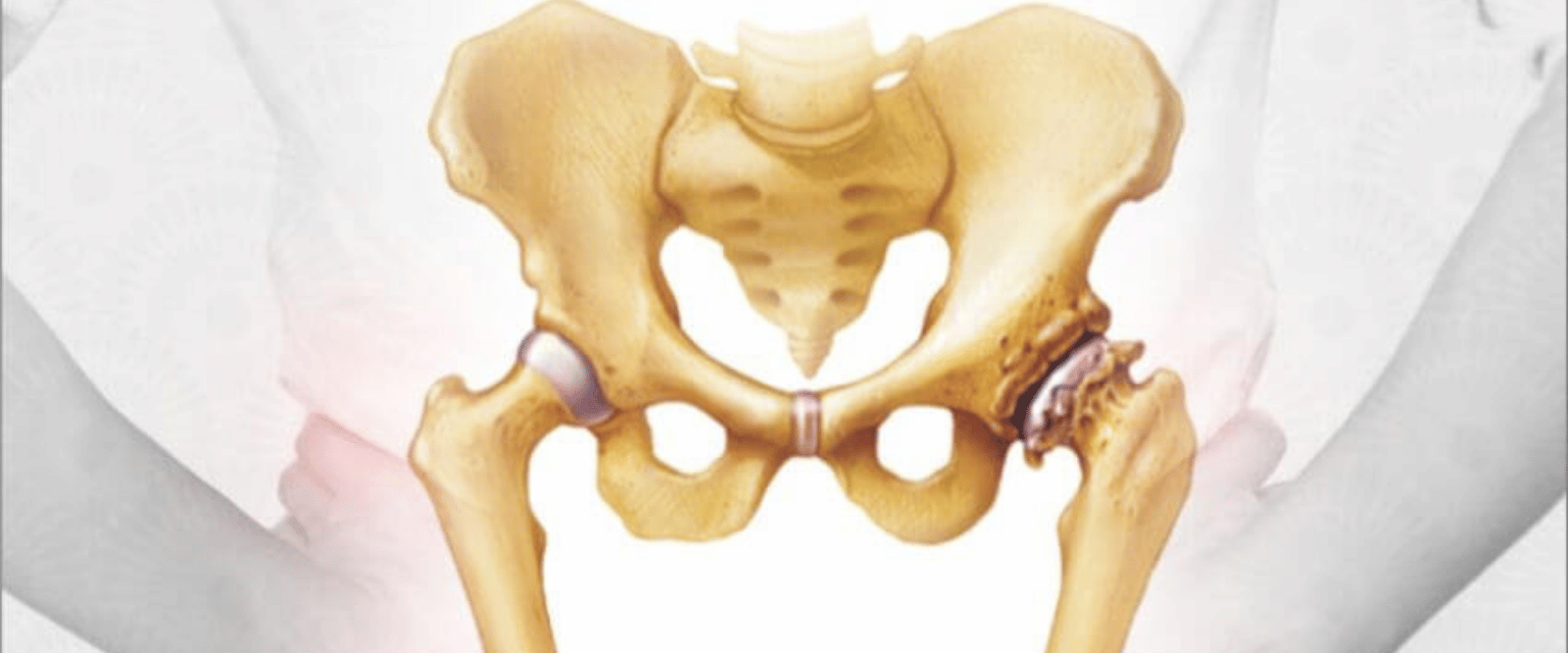 Total Hip Replacement