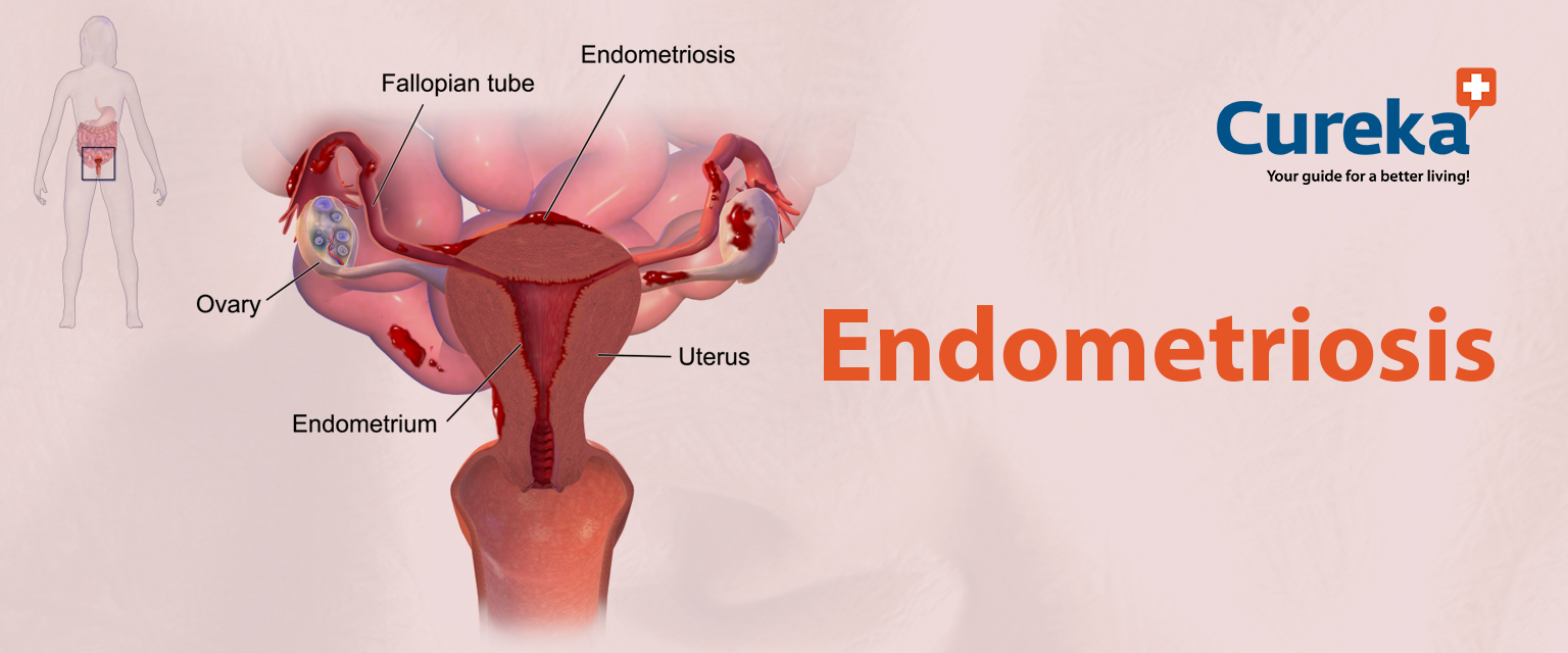 Endometriosis