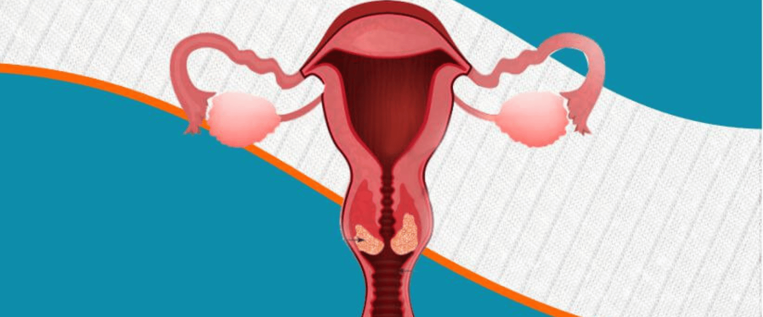What Is Cervical Cancer?
