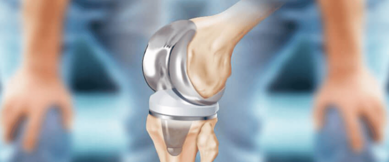 Joint Replacement Surgery A Successful Treatment