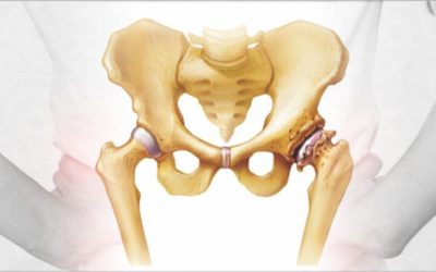 hip-replacement explnation by ortho surgeon