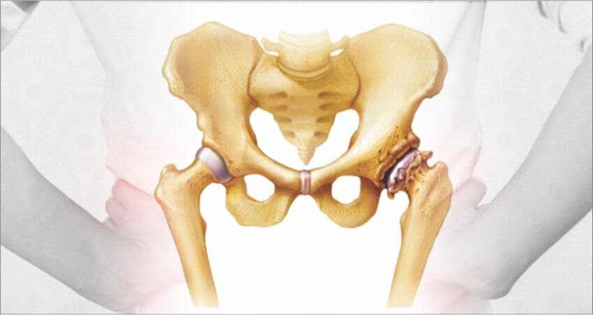 hip-replacement explnation by ortho surgeon