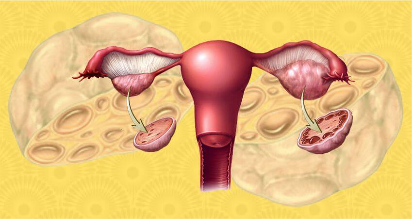 Polycystic Ovarian Syndrome