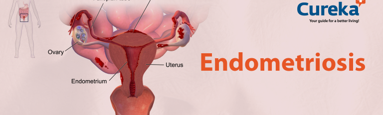 Endometriosis