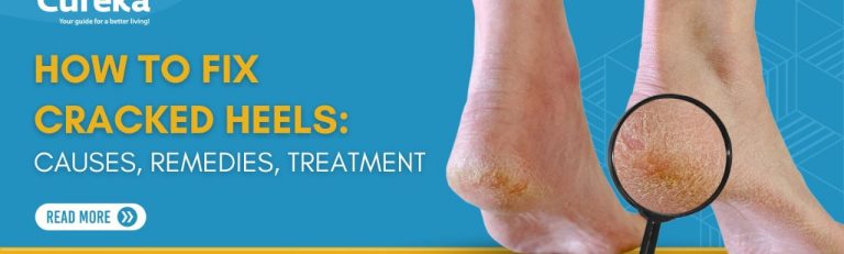 How To Fix Cracked Heels: Causes, Remedies, Treatment